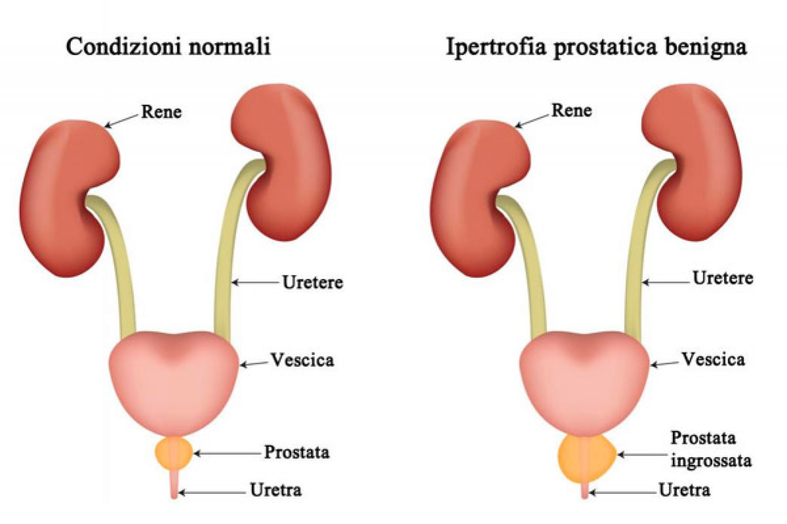 prostatoliti